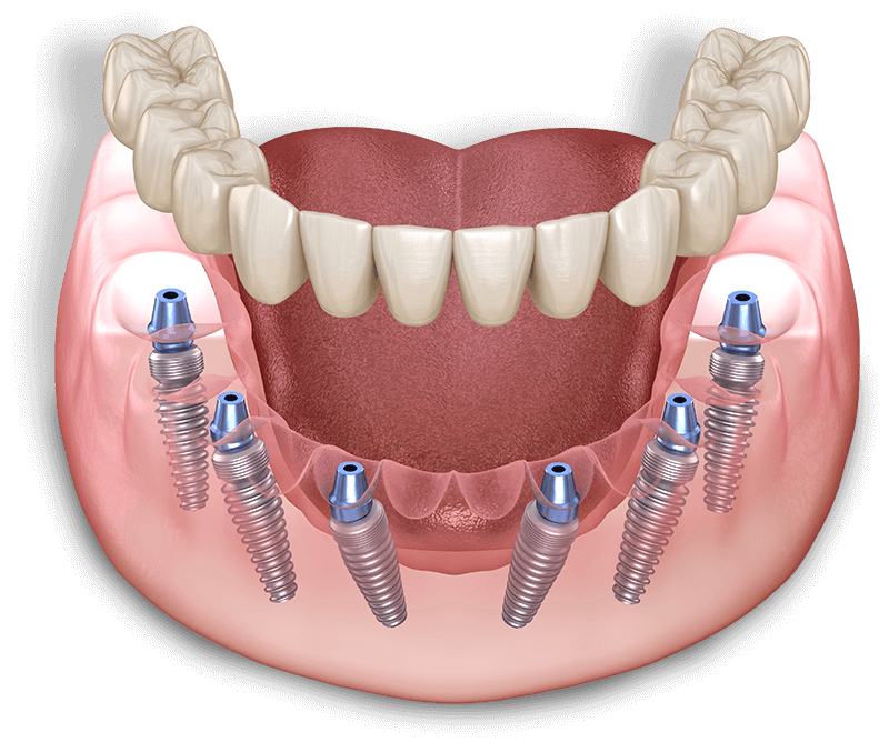 full arch dental model