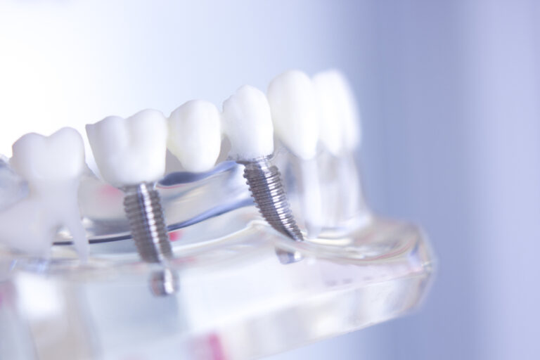 Dentist consulting with a patient about dental implants in a modern dental office